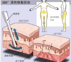 韩国seroi德社伊整形吸脂示意图